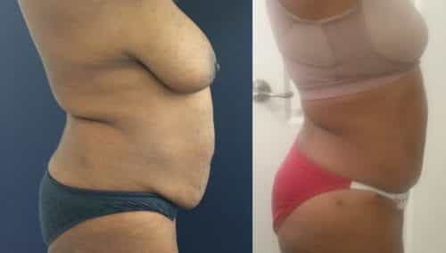 Before and after Mommy Makeover Colombia - Premium Care Plastic Surgery