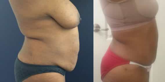 Before and after Mommy Makeover Colombia - Premium Care Plastic Surgery