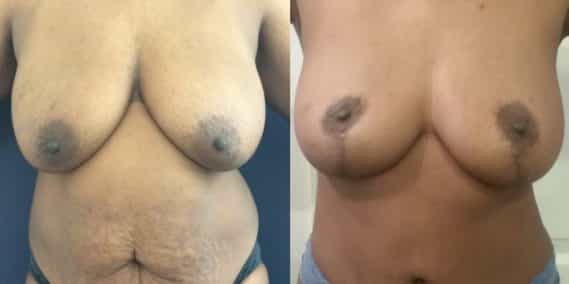 Before and after Mommy Makeover Colombia - Premium Care Plastic Surgery