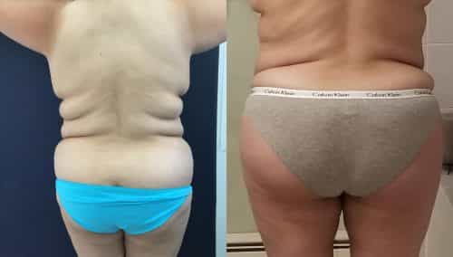 Before and after Mommy Makeover Colombia - Premium Care Plastic Surgery