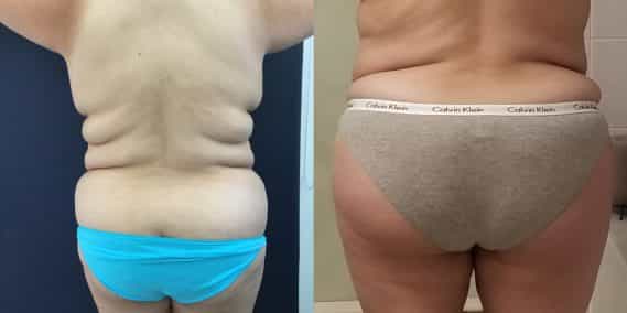 Before and after Mommy Makeover Colombia - Premium Care Plastic Surgery