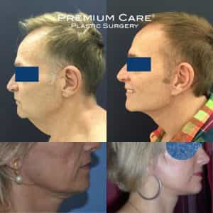 Neck Lift in Colombia - Premium Care Medical Suites