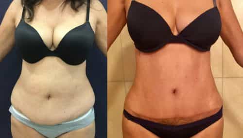 Before and after Mommy Makeover Colombia - Premium Care Plastic Surgery