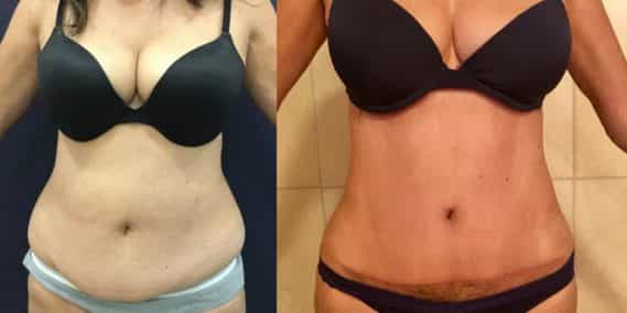 Before and after Mommy Makeover Colombia - Premium Care Plastic Surgery