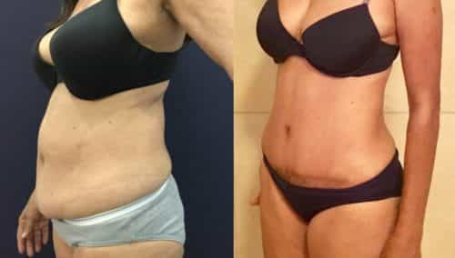 Before and after Mommy Makeover Colombia - Premium Care Plastic Surgery