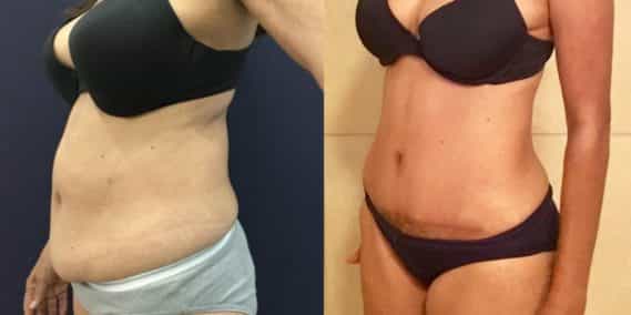 Before and after Mommy Makeover Colombia - Premium Care Plastic Surgery