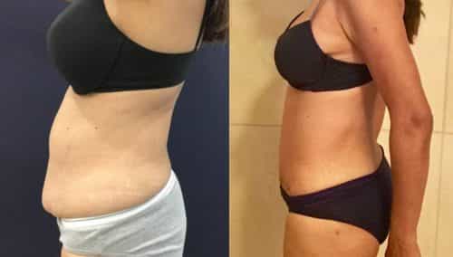 Before and after Mommy Makeover Colombia - Premium Care Plastic Surgery