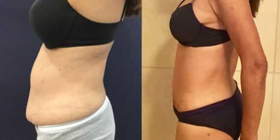 Before and after Mommy Makeover Colombia - Premium Care Plastic Surgery