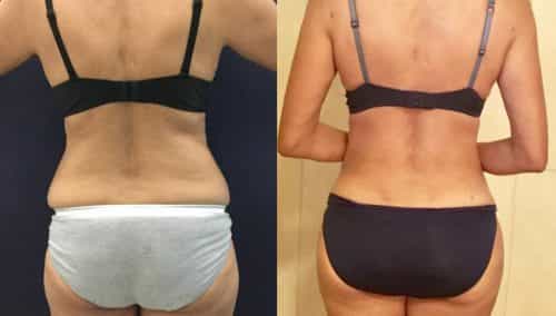 Before and after Mommy Makeover Colombia - Premium Care Plastic Surgery