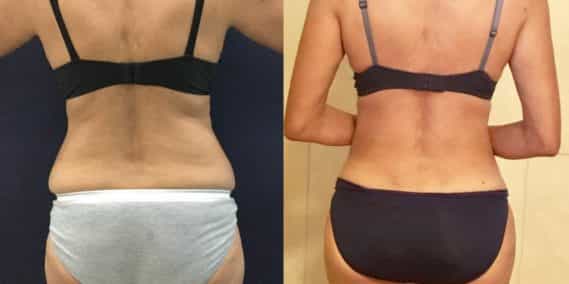 Before and after Mommy Makeover Colombia - Premium Care Plastic Surgery