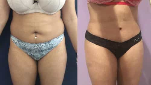 Before and After Liposuction Colombia - Premium Care Plastic Surgery