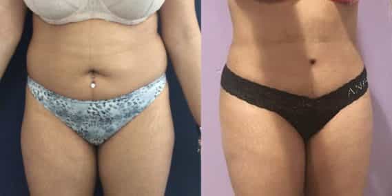 Before and after Mommy Makeover Colombia - Premium Care Plastic Surgery