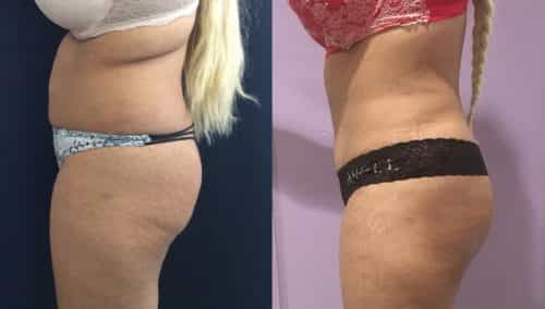 Before and after Mommy Makeover Colombia - Premium Care Plastic Surgery