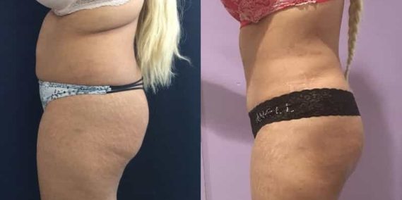 Before and after Mommy Makeover Colombia - Premium Care Plastic Surgery