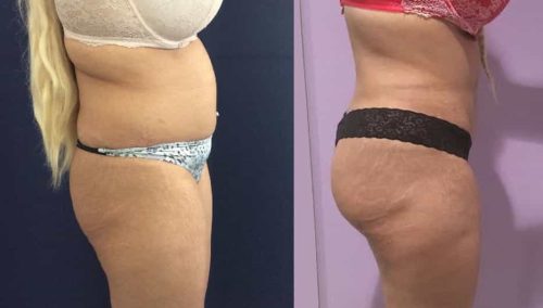 Before and after Mommy Makeover Colombia - Premium Care Plastic Surgery