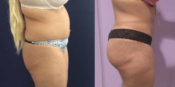 Before and after Mommy Makeover Colombia - Premium Care Plastic Surgery