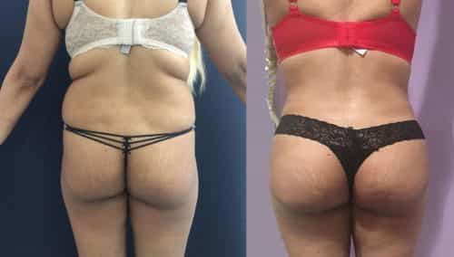 Before and after Mommy Makeover Colombia - Premium Care Plastic Surgery