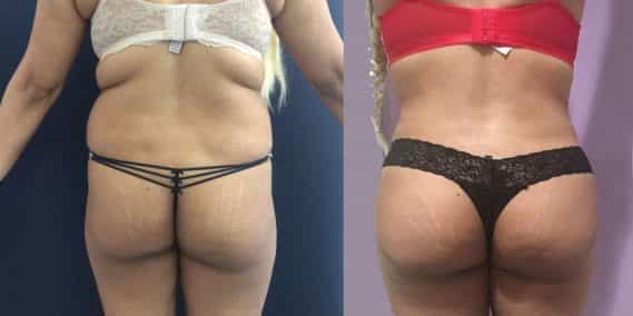 Before and after Mommy Makeover Colombia - Premium Care Plastic Surgery