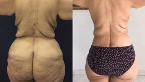 Before and After Posterior Body Lift Colombia - Premium Care Plastic Surgery