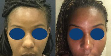 Before and After - Rhinoplasty Colombia - Premium Care Plastic Surgery