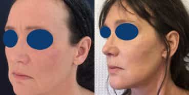 Before and After - Rhinoplasty Colombia - Premium Care Plastic Surgery