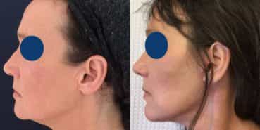 Before and After - Rhinoplasty Colombia - Premium Care Plastic Surgery