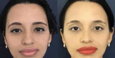 Before and After - Rhinoplasty Colombia - Premium Care Plastic Surgery