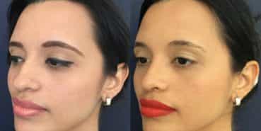 Before and After - Rhinoplasty Colombia - Premium Care Plastic Surgery