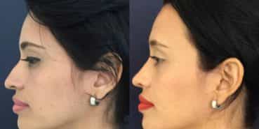 Before and After - Rhinoplasty Colombia - Premium Care Plastic Surgery