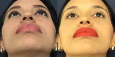 Before and After - Rhinoplasty Colombia - Premium Care Plastic Surgery