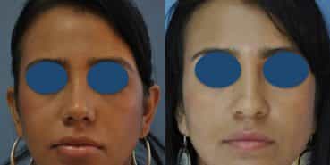 Before and After - Rhinoplasty Colombia - Premium Care Plastic Surgery