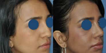 Before and After - Rhinoplasty Colombia - Premium Care Plastic Surgery