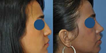 Before and After - Rhinoplasty Colombia - Premium Care Plastic Surgery