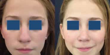 Before and After - Rhinoplasty Colombia - Premium Care Plastic Surgery