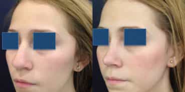 Before and After - Rhinoplasty Colombia - Premium Care Plastic Surgery