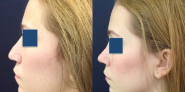 Before and After - Rhinoplasty Colombia - Premium Care Plastic Surgery