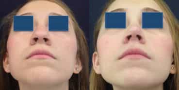 Before and After - Rhinoplasty Colombia - Premium Care Plastic Surgery