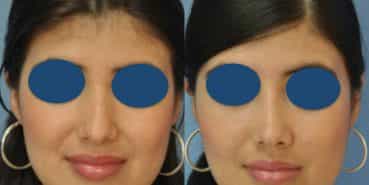 Before and After - Rhinoplasty Colombia - Premium Care Plastic SurgeryRhinoplasty Cartagena Colombia - Premium Care Plastic Surgery