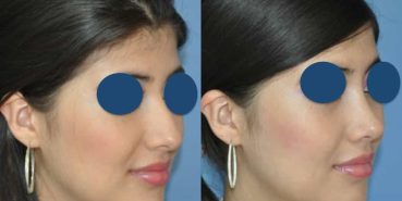 Before and After - Rhinoplasty Colombia - Premium Care Plastic Surgery