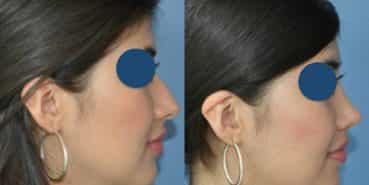 Before and After - Rhinoplasty Colombia - Premium Care Plastic Surgery