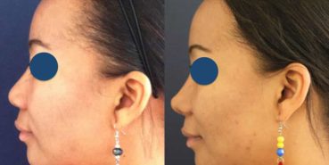 Before and After - Rhinoplasty Colombia - Premium Care Plastic Surgery