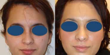 Before and After - Rhinoplasty Colombia - Premium Care Plastic Surgery