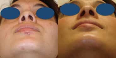 Before and After - Rhinoplasty Colombia - Premium Care Plastic Surgery