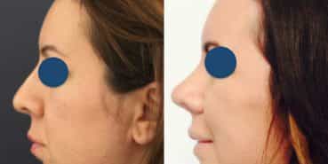 Before and After - Rhinoplasty Colombia - Premium Care Plastic Surgery