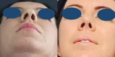 Before and After - Rhinoplasty Colombia - Premium Care Plastic Surgery