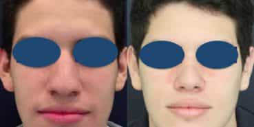 Before and After - Rhinoplasty Colombia - Premium Care Plastic Surgery