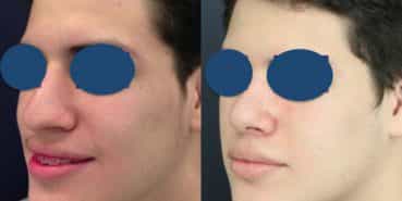 Before and After - Rhinoplasty Colombia - Premium Care Plastic Surgery