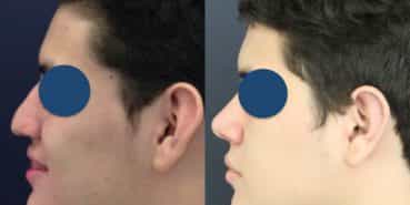 Before and After - Rhinoplasty Colombia - Premium Care Plastic Surgery