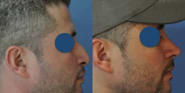 Before and After - Rhinoplasty Colombia - Premium Care Plastic Surgery