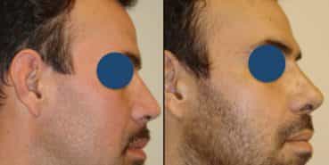 Before and After - Rhinoplasty Colombia - Premium Care Plastic Surgery